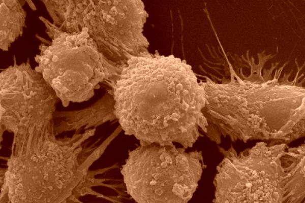 Cancer Biology Enlargement of Cancer Cells.