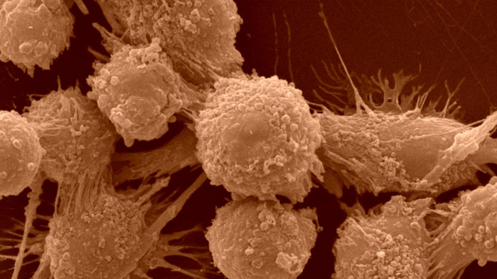 Enlargement of Cancer Cells.